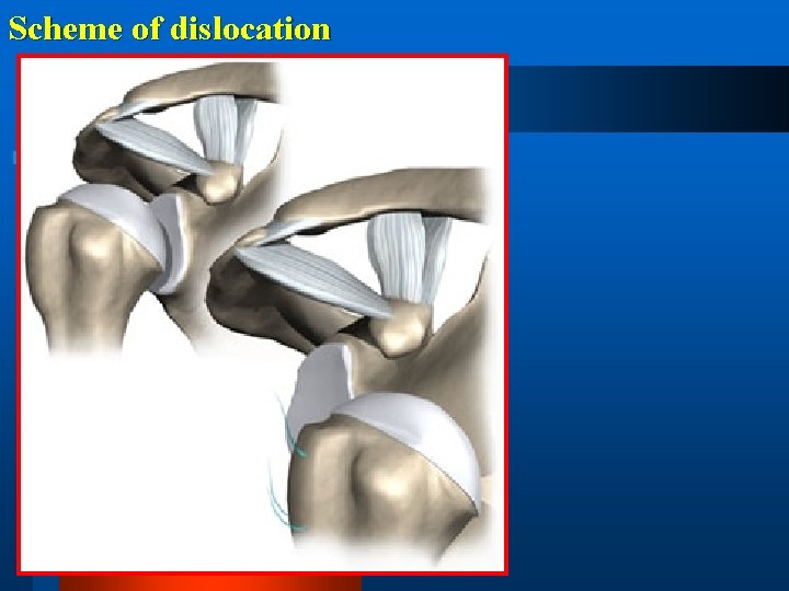 Scheme of dislocation 