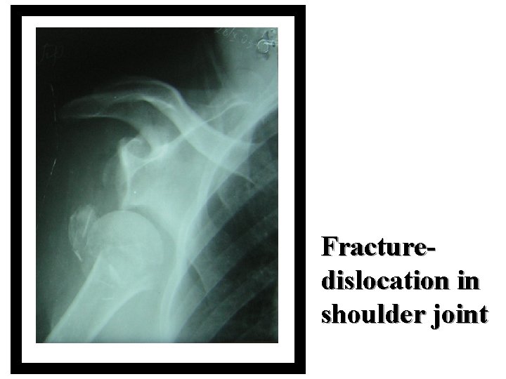 Fracturedislocation in shoulder joint 