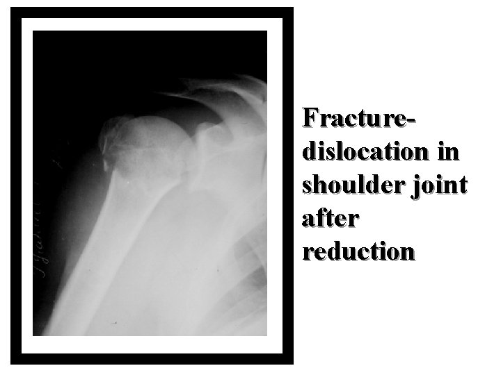 Fracturedislocation in shoulder joint after reduction 
