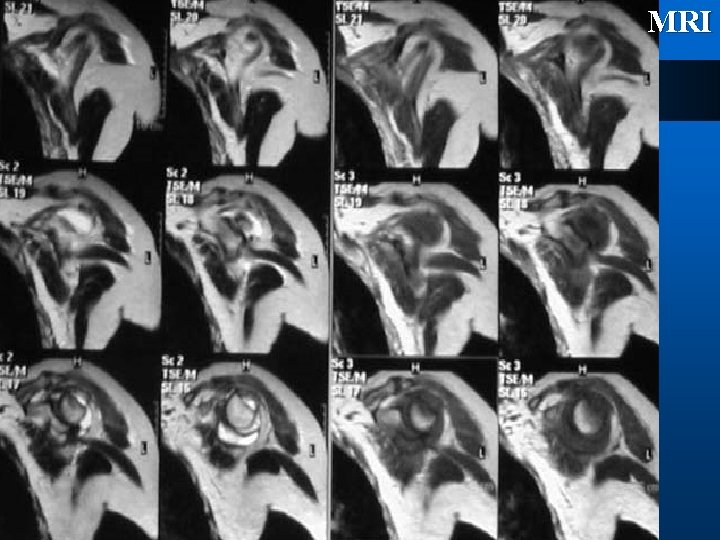 MRI 