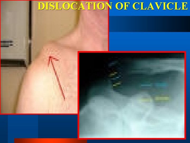 DISLOCATION OF CLAVICLE 