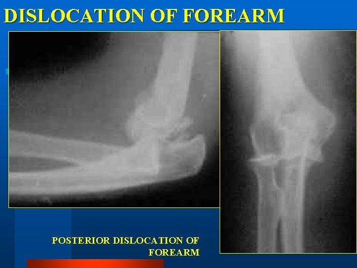 DISLOCATION OF FOREARM POSTERIOR DISLOCATION OF FOREARM 