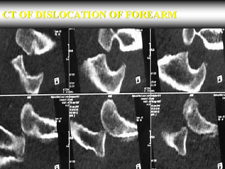 CT OF DISLOCATION OF FOREARM 