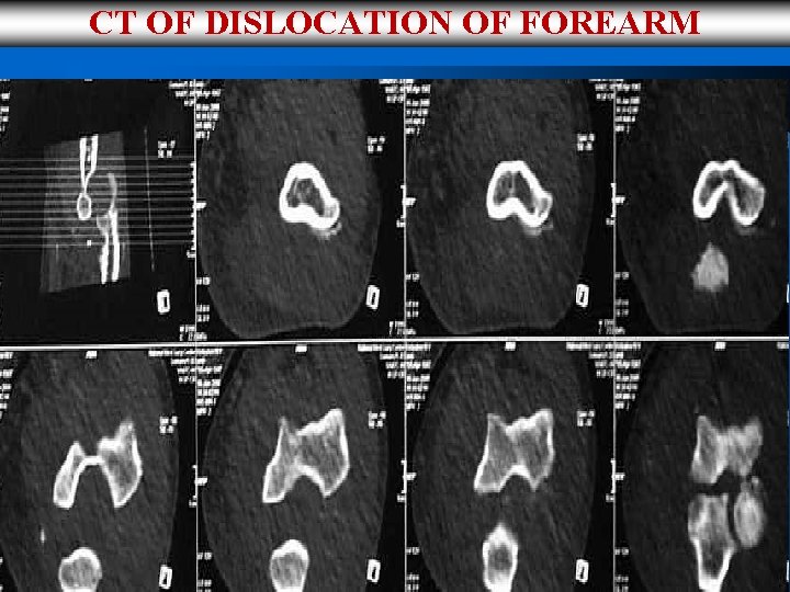 CT OF DISLOCATION OF FOREARM 