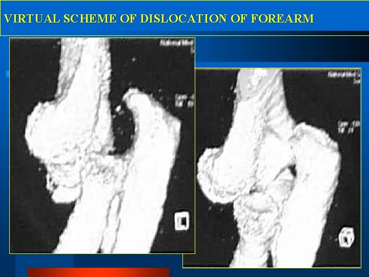 VIRTUAL SCHEME OF DISLOCATION OF FOREARM 