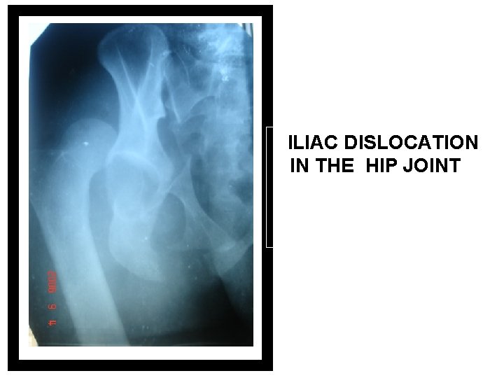ILIAC DISLOCATION IN THE HIP JOINT 