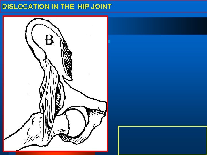 DISLOCATION IN THE HIP JOINT 