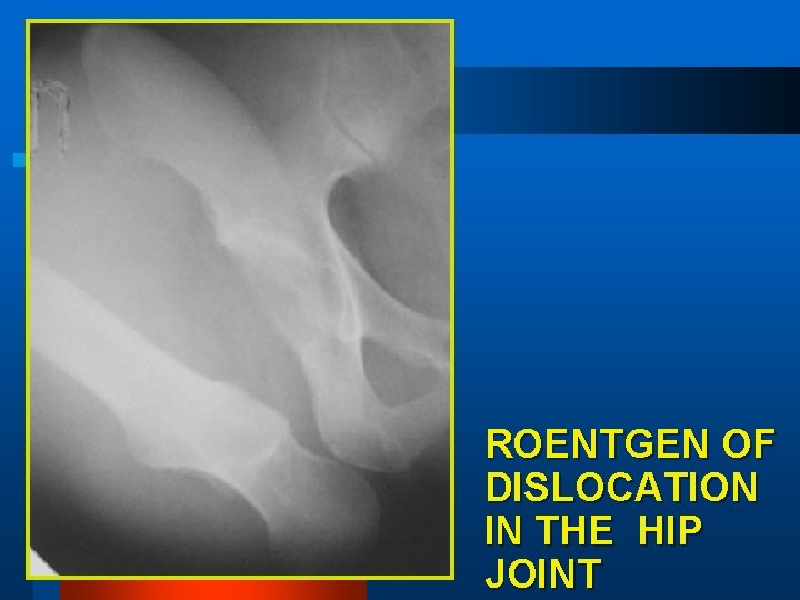 ROENTGEN OF DISLOCATION IN THE HIP JOINT 