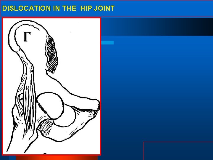 DISLOCATION IN THE HIP JOINT 