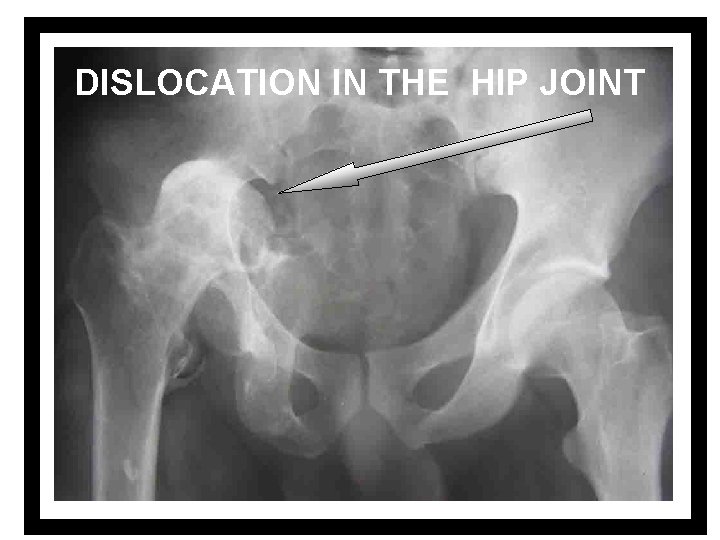 DISLOCATION IN THE HIP JOINT 