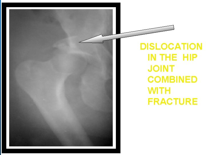 DISLOCATION IN THE HIP JOINT COMBINED WITH FRACTURE 