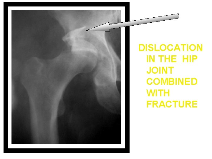 DISLOCATION IN THE HIP JOINT COMBINED WITH FRACTURE 