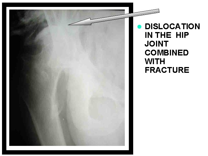 l DISLOCATION IN THE HIP JOINT COMBINED WITH FRACTURE 