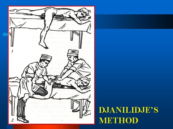 DJANILIDJE’S METHOD 