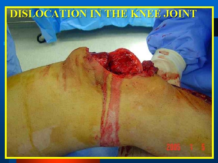 DISLOCATION IN THE KNEE JOINT 