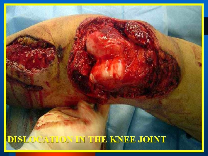 DISLOCATION IN THE KNEE JOINT 