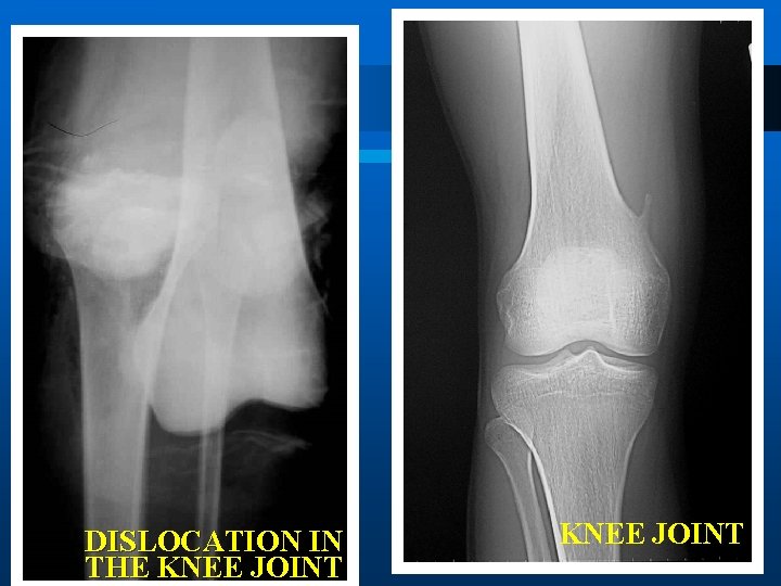 DISLOCATION IN THE KNEE JOINT 