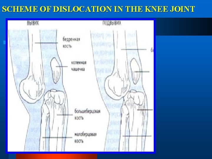 SCHEME OF DISLOCATION IN THE KNEE JOINT 