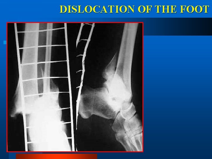 DISLOCATION OF THE FOOT 