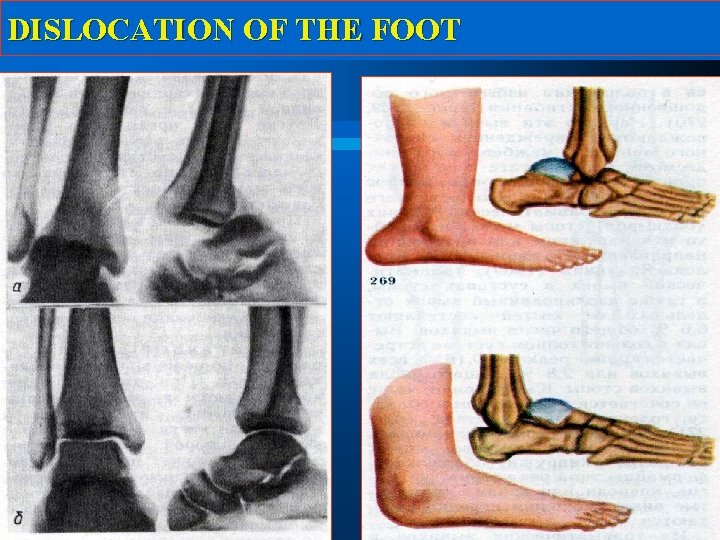 DISLOCATION OF THE FOOT 