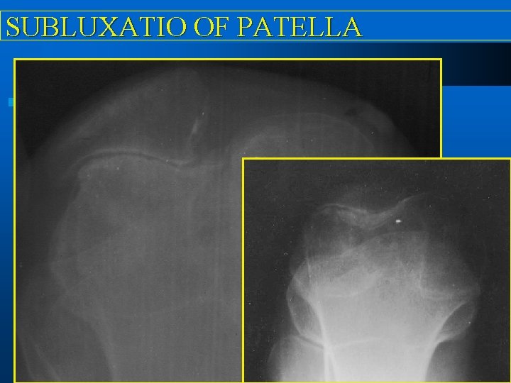 SUBLUXATIO OF PATELLA 