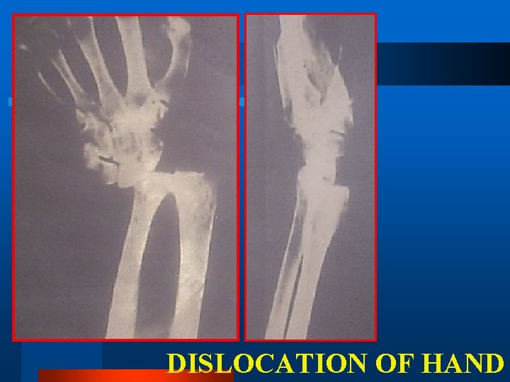 DISLOCATION OF HAND 