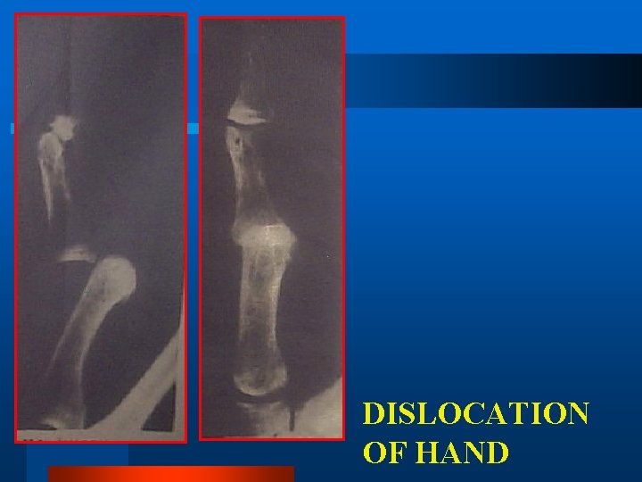 DISLOCATION OF HAND 