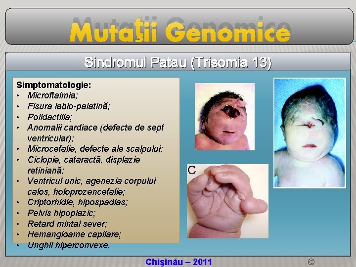 Mutaţii Genomice Sindromul Patau (Trisomia 13) Simptomatologie: • Microftalmia; • Fisura labio-palatină; • Polidactilia;