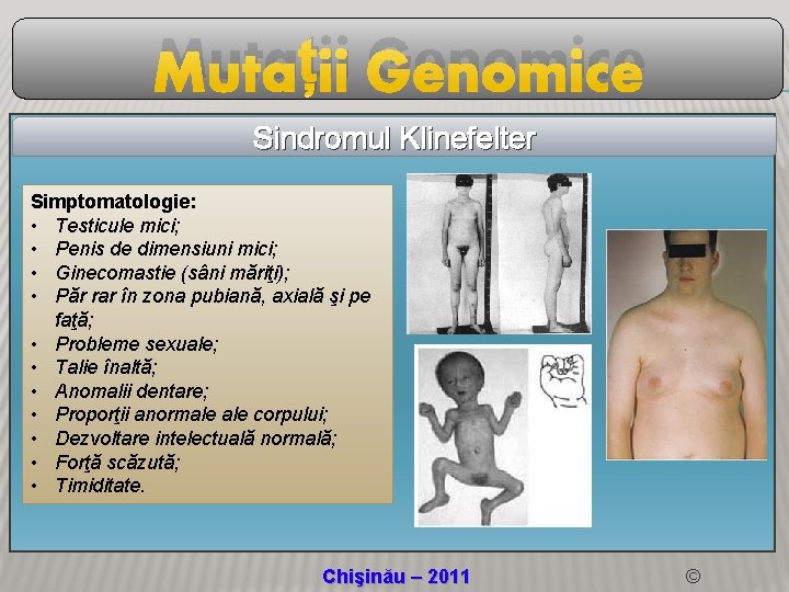 Mutații Genomice Sindromul Klinefelter Simptomatologie: • Testicule mici; • Penis de dimensiuni mici; •