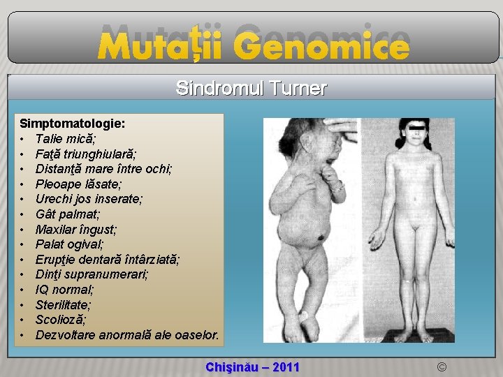 Mutații Genomice Sindromul Turner Simptomatologie: • Talie mică; • Faţă triunghiulară; • Distanţă mare