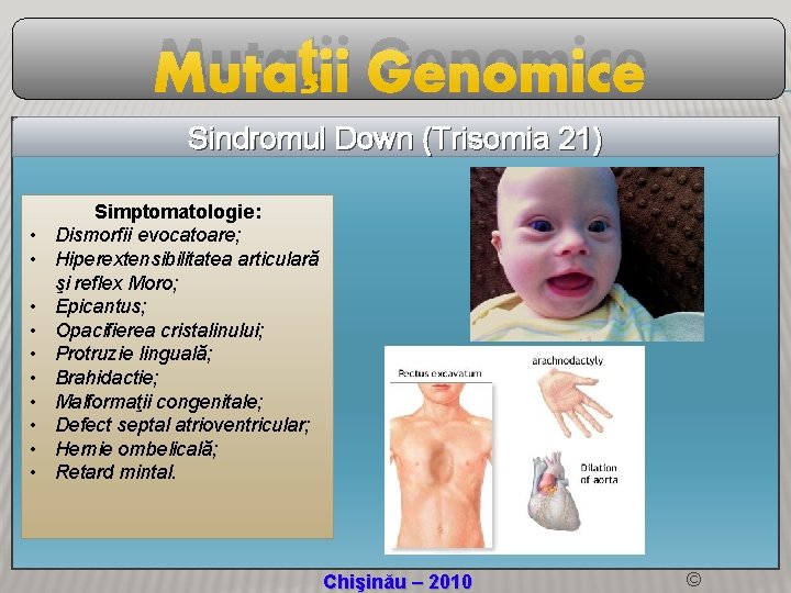 Mutaţii Genomice Sindromul Down (Trisomia 21) • • • Simptomatologie: Dismorfii evocatoare; Hiperextensibilitatea articulară