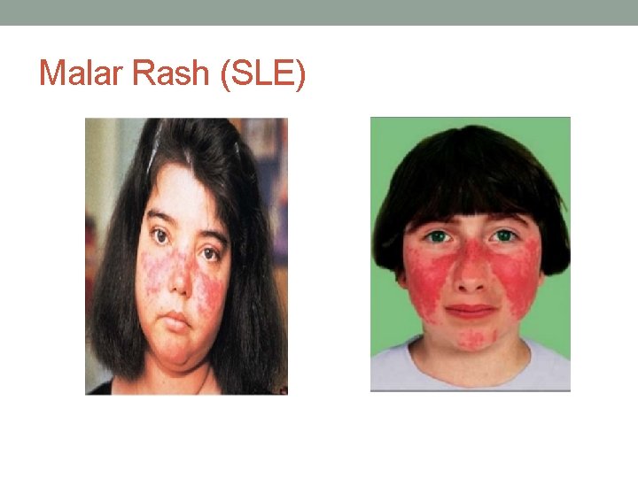 Malar Rash (SLE) 