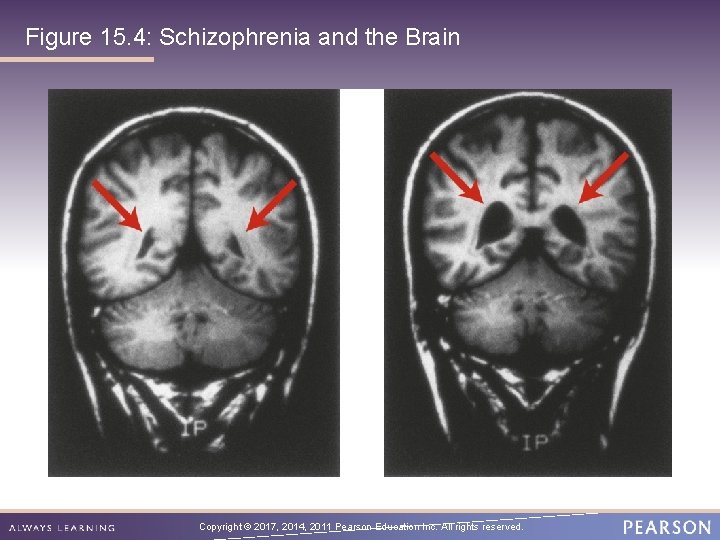 Figure 15. 4: Schizophrenia and the Brain Copyright © 2017, 2014, 2011 Pearson Education