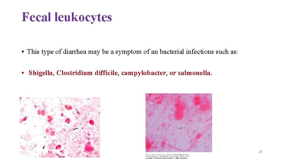 Fecal leukocytes • This type of diarrhea may be a symptom of an bacterial