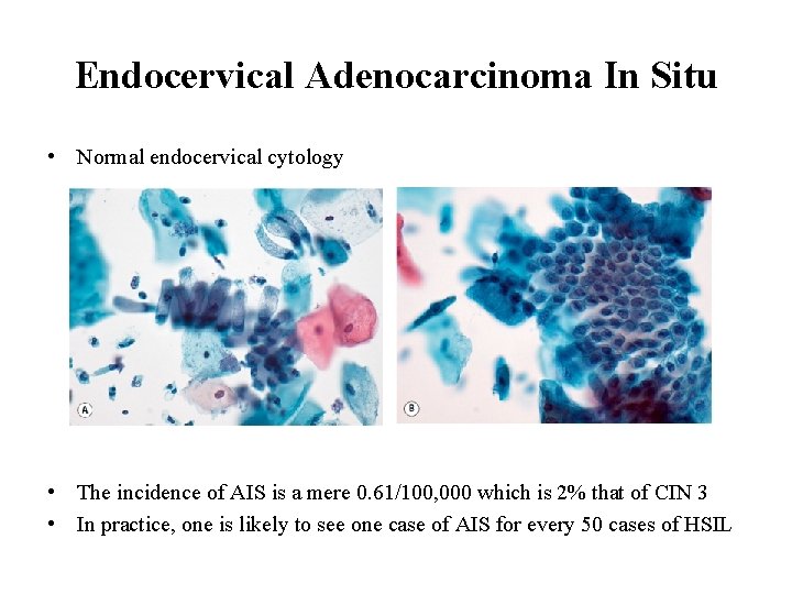 Endocervical Adenocarcinoma In Situ • Normal endocervical cytology • The incidence of AIS is