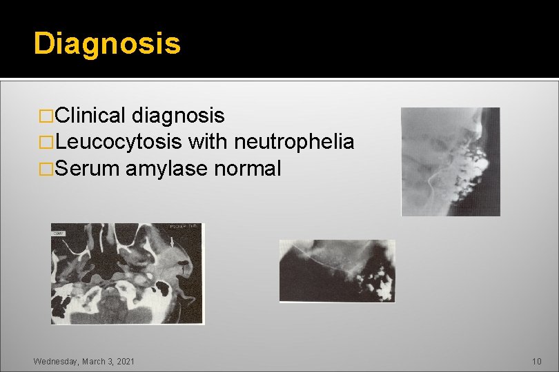Diagnosis �Clinical diagnosis �Leucocytosis with neutrophelia �Serum amylase normal Wednesday, March 3, 2021 10