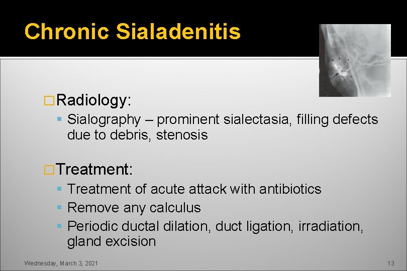 Chronic Sialadenitis �Radiology: Sialography – prominent sialectasia, filling defects due to debris, stenosis �Treatment: