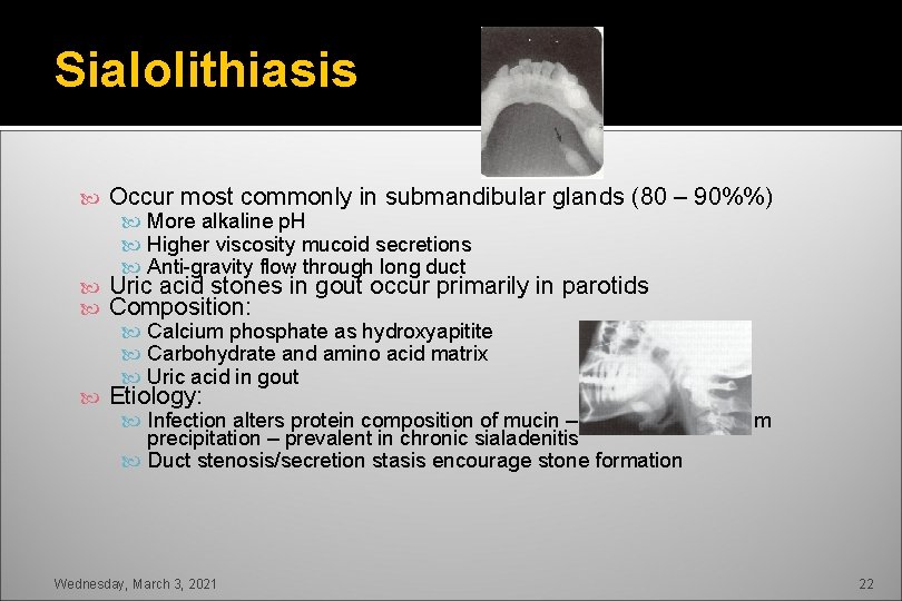 Sialolithiasis Occur most commonly in submandibular glands (80 – 90%%) More alkaline p. H