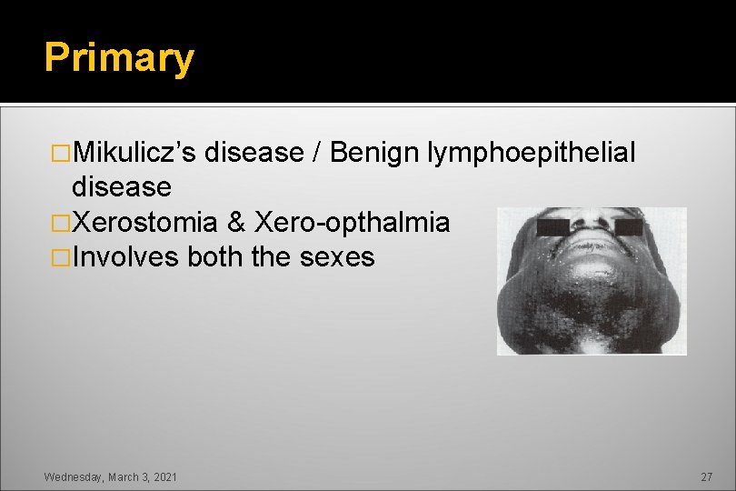 Primary �Mikulicz’s disease / Benign lymphoepithelial disease �Xerostomia & Xero-opthalmia �Involves both the sexes