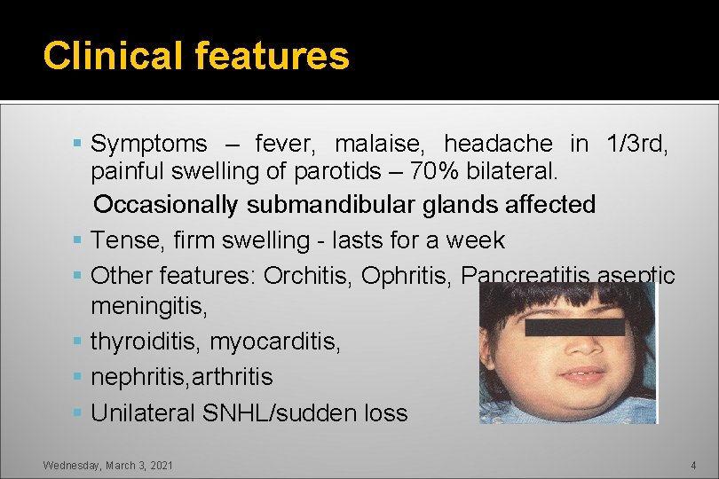 Clinical features Symptoms – fever, malaise, headache in 1/3 rd, painful swelling of parotids