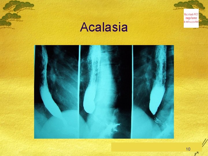Acalasia C. Feo, Esofago-Stomaco-Duodeno 10 