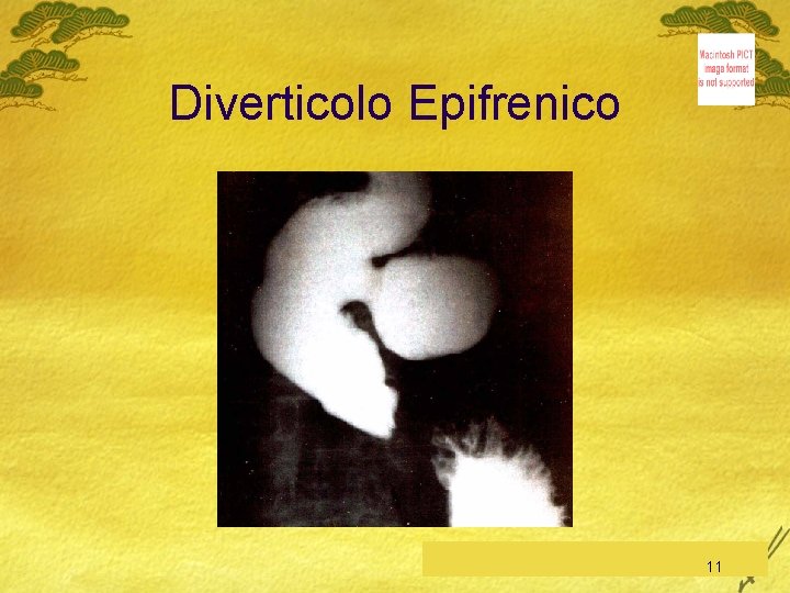 Diverticolo Epifrenico C. Feo, Esofago-Stomaco-Duodeno 11 