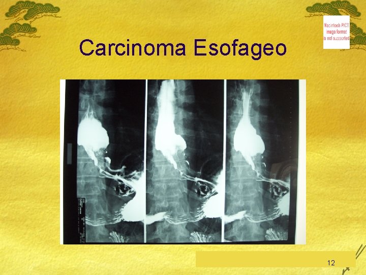 Carcinoma Esofageo C. Feo, Esofago-Stomaco-Duodeno 12 