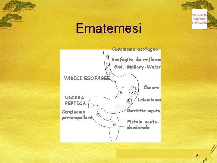 Ematemesi Carcinoma esofageo Esofagite da reflusso Snd. Mallory-Weiss VARICI ESOFAGEE Cancro ULCERA PEPTICA Carcinoma
