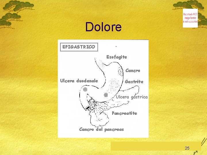 Dolore EPIGASTRICO Esofagite Cancro Ulcera duodenale Gastrite Ulcera gastrica Pancreatite Cancro del pancreas C.