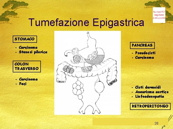 Tumefazione Epigastrica STOMACO - Carcinoma - Stenosi pilorica PANCREAS - Pseudocisti - Carcinoma COLON