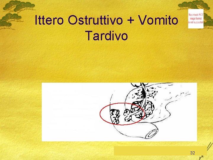 Ittero Ostruttivo + Vomito Tardivo C. Feo, Esofago-Stomaco-Duodeno 32 