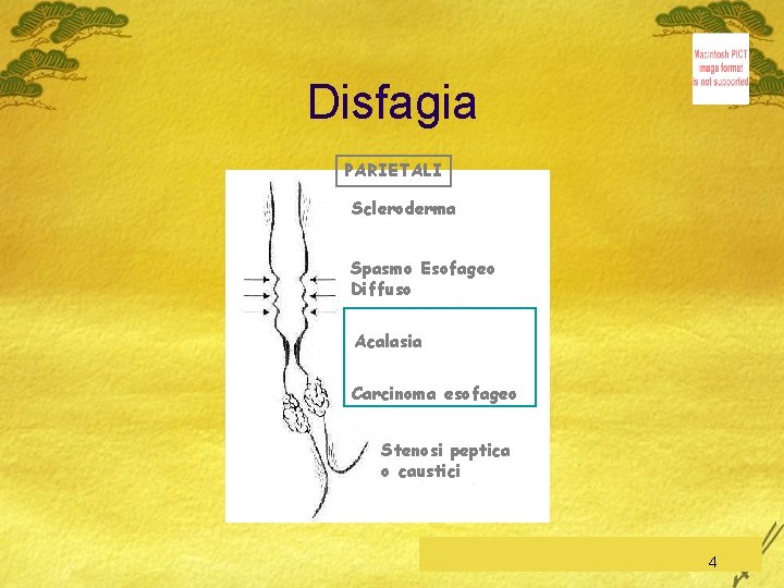 Disfagia PARIETALI Scleroderma Spasmo Esofageo Diffuso Acalasia Carcinoma esofageo Stenosi peptica o caustici C.