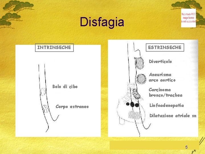 Disfagia INTRINSECHE ESTRINSECHE Diverticolo Aneurisma arco aortico Bolo di cibo Corpo estraneo Carcinoma bronco/trachea