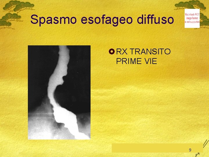 Spasmo esofageo diffuso £ RX TRANSITO PRIME VIE C. Feo, Esofago-Stomaco-Duodeno 9 